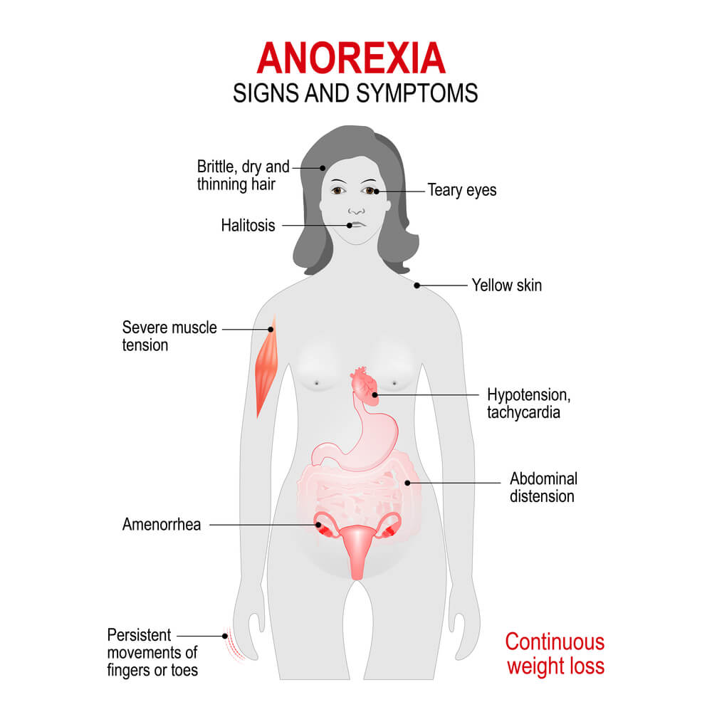 Symptômes de l'anorexie. 
