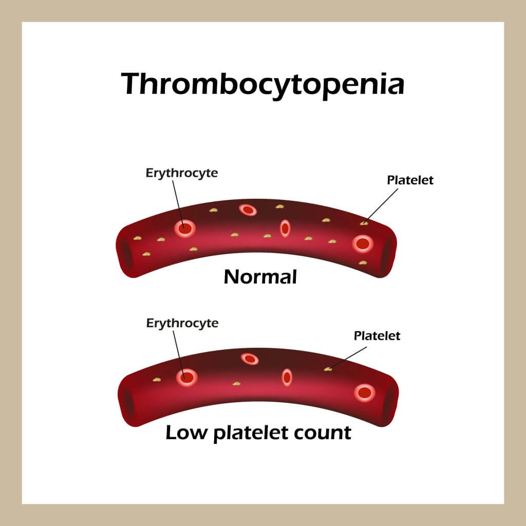 thrombocytopénie