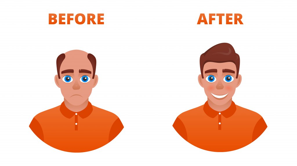 alopecia cuero cabelludo pelo