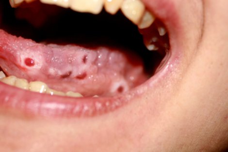 Candidiasis