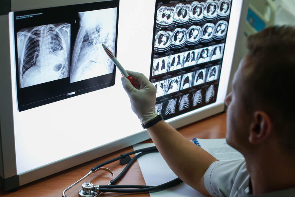 Ipertensione polmonare: medico valuta radiografia dei polmoni