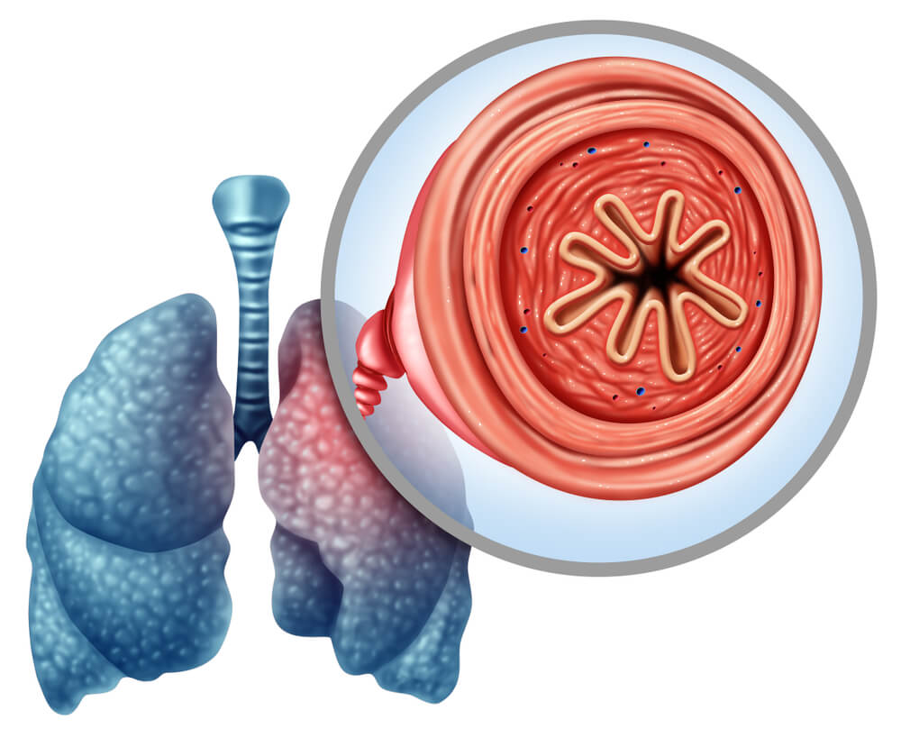 Las diferencias entre bronquitis y neumonía incluyen el origen anatómico
