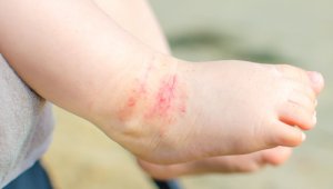 La dermatitis