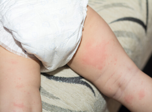 dermatitis