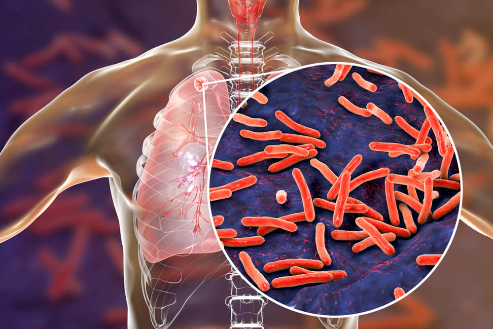 tuberculose mycobactéries bactéries antibiotiques bacille