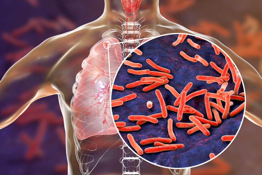 tuberculosis bacteriana bacilo mycobacterium