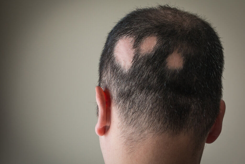 Los tipos de alopecia incluyen la areata