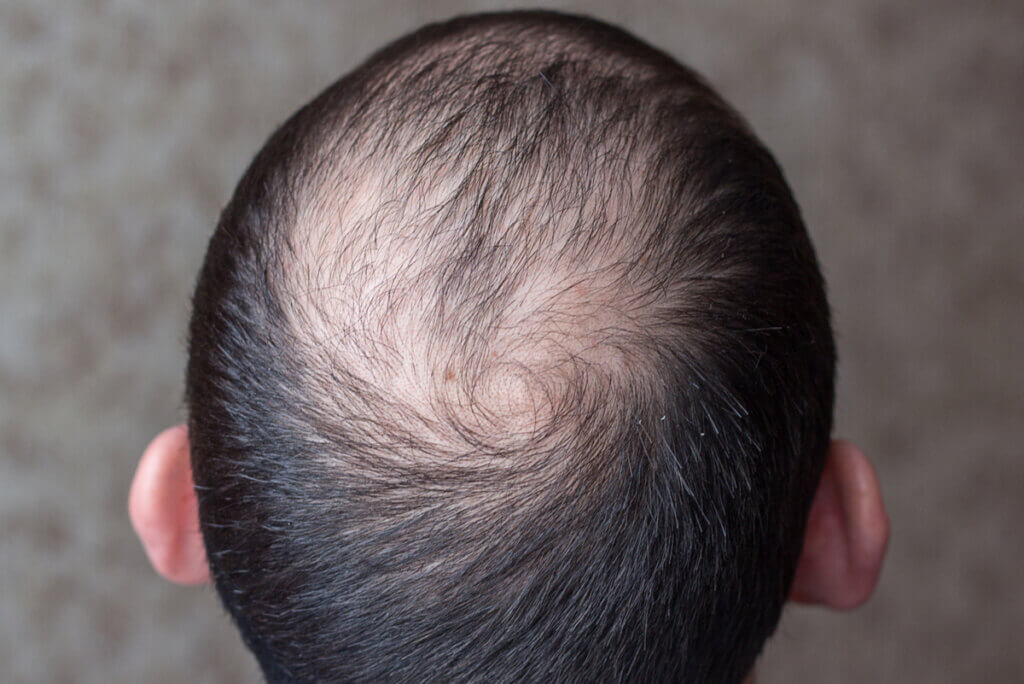 Alopecia masculina.