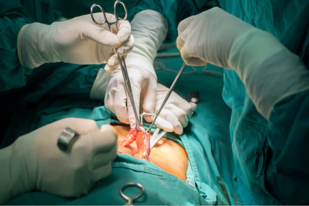 The surgical removal of the appendix.