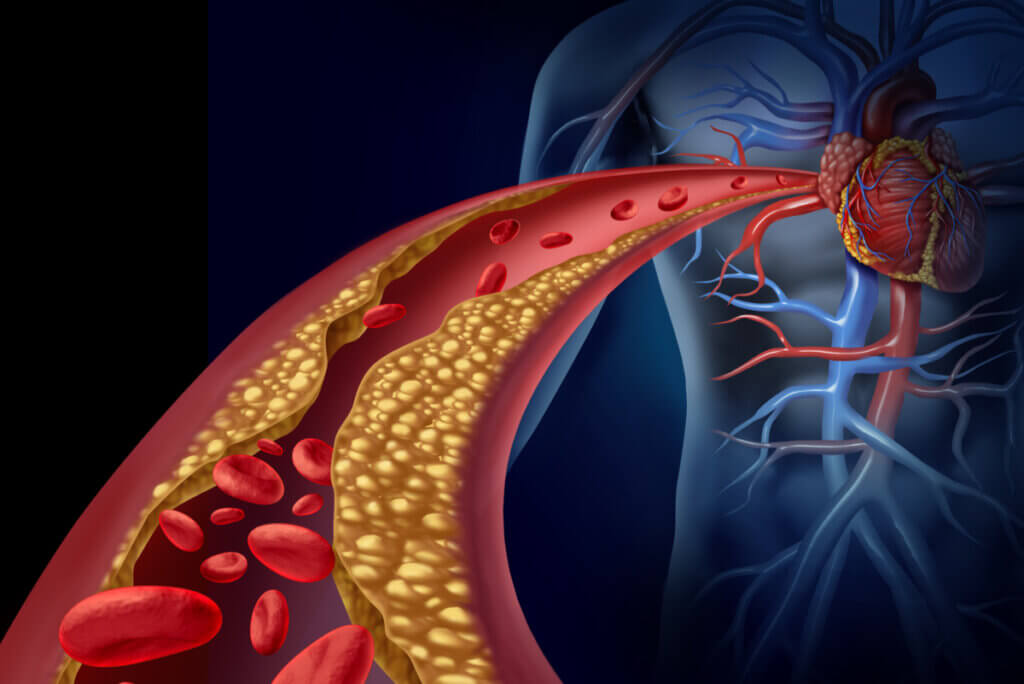Arterosclerosis por colesterol.