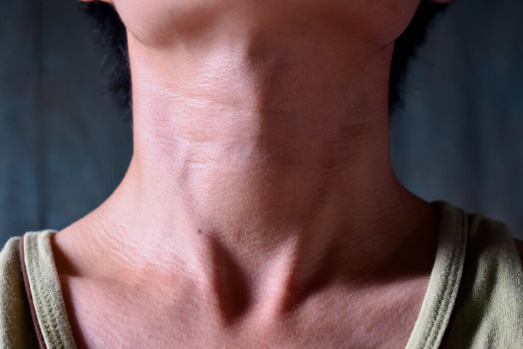 Goiter in a patient who needs thyroid medication.