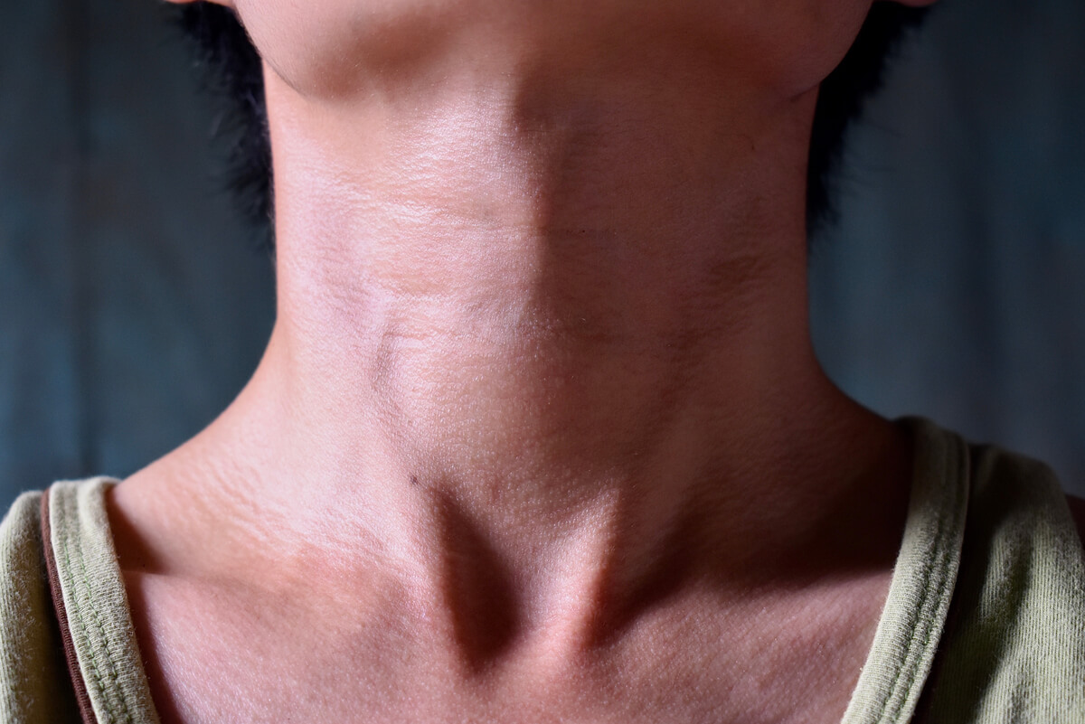 El alcohol y la función tiroidea se expresan como hipotiroidismo