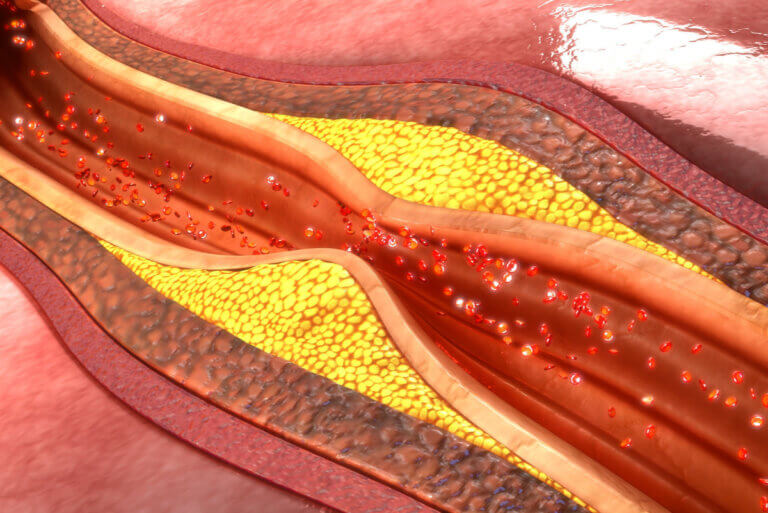 Hipercolesterolemia: síntomas, causas y tratamiento