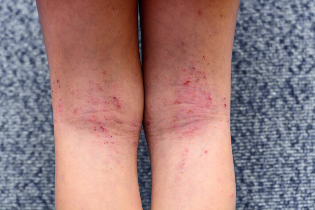 Dermatitis en las piernas.