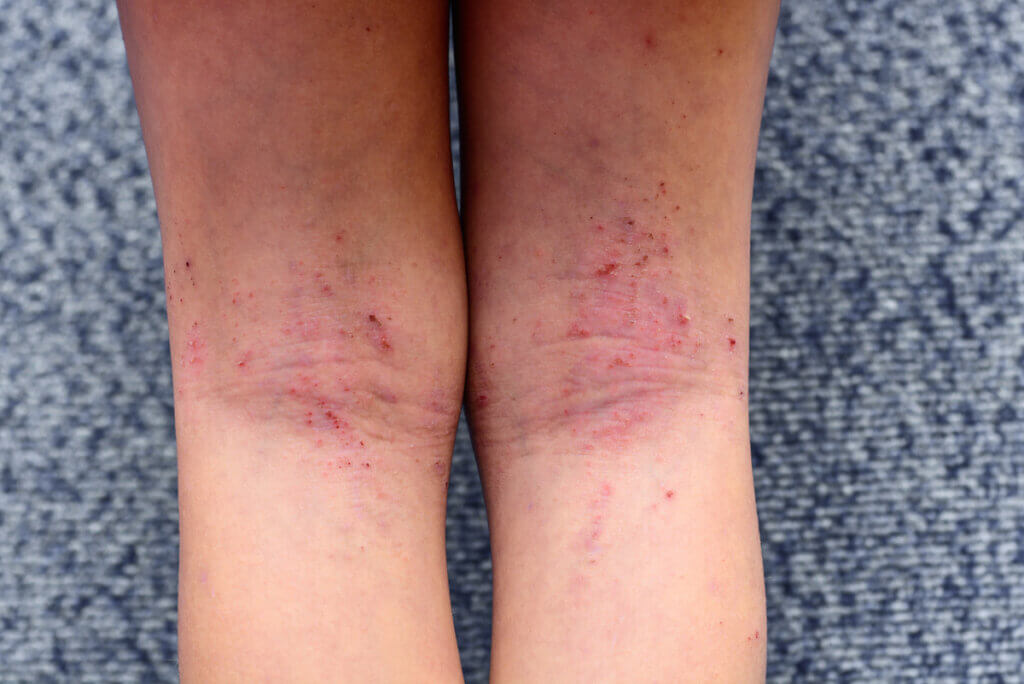 Acné mecánico en las piernas.
