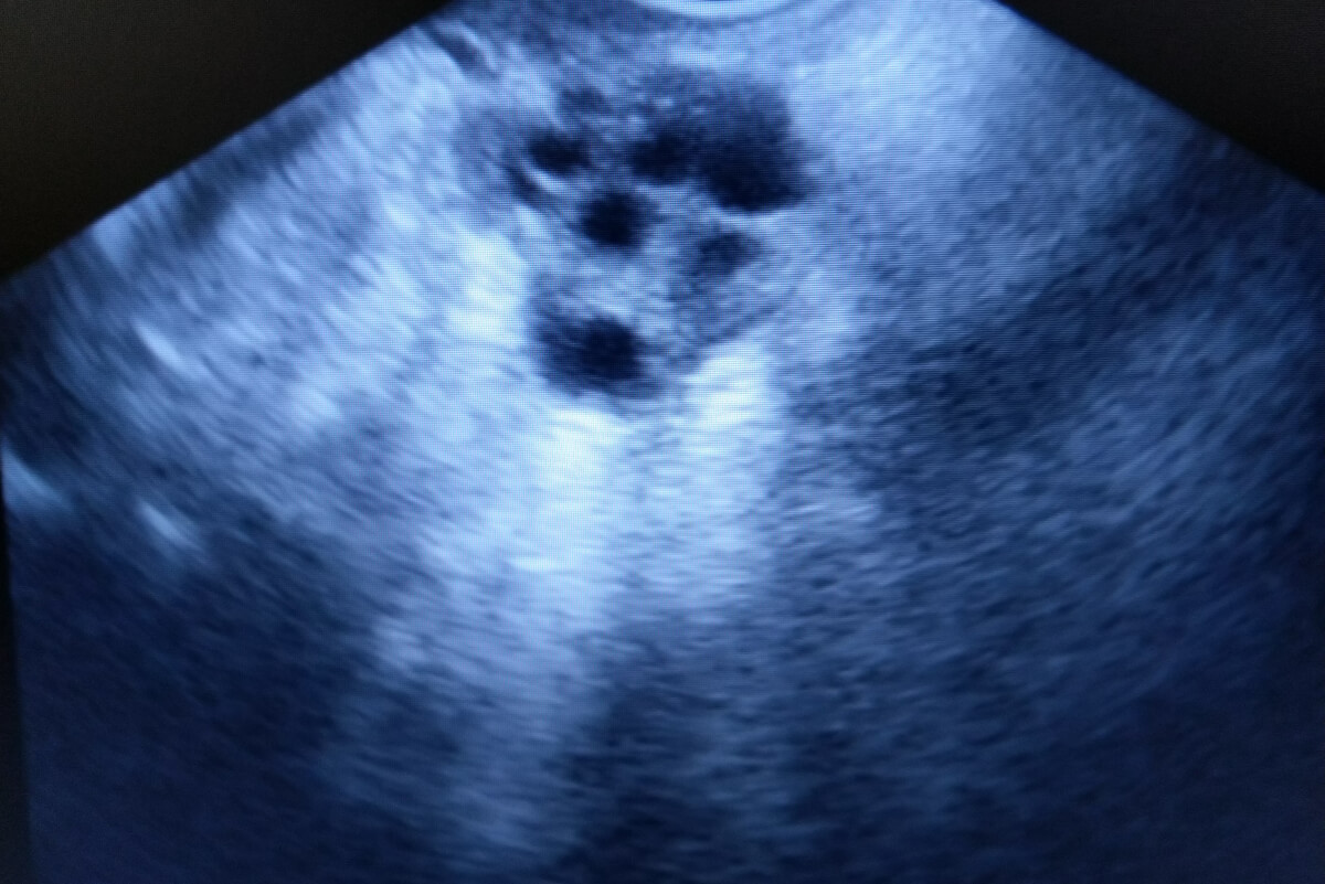 An ultrasound image of the breast.