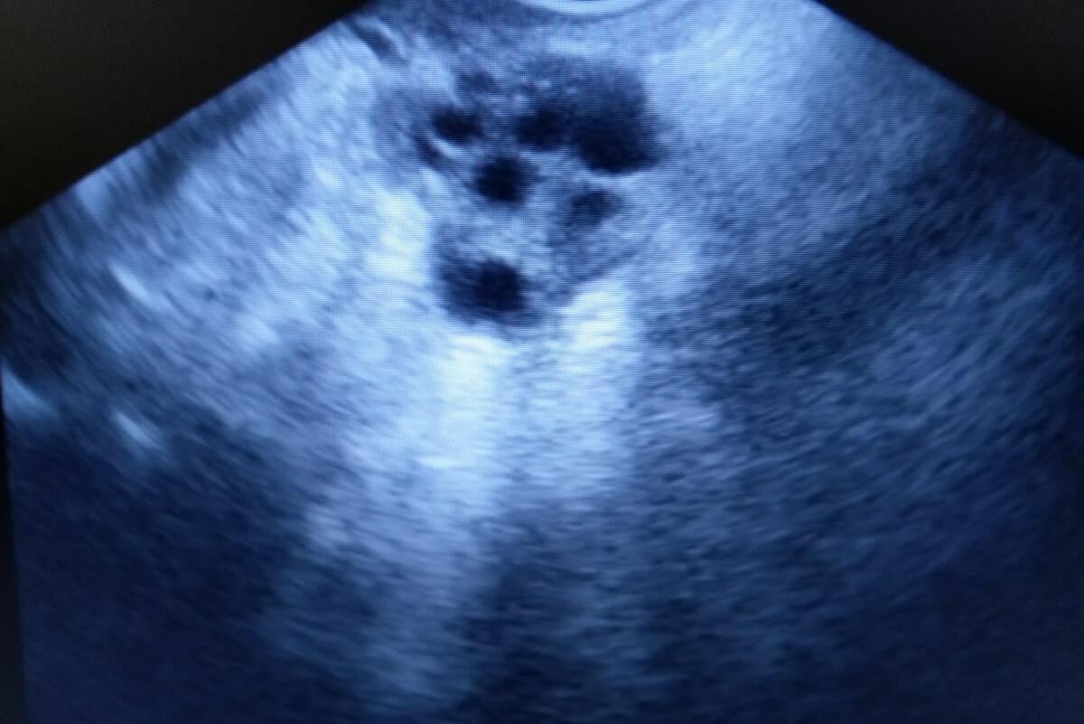El diagnóstico del cáncer de mama incluye el uso de un ecosonograma mamario