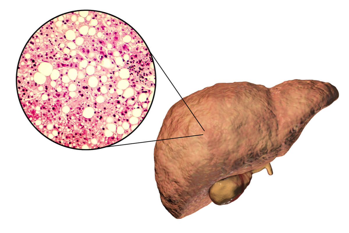 4 señales que alertan del hígado graso
