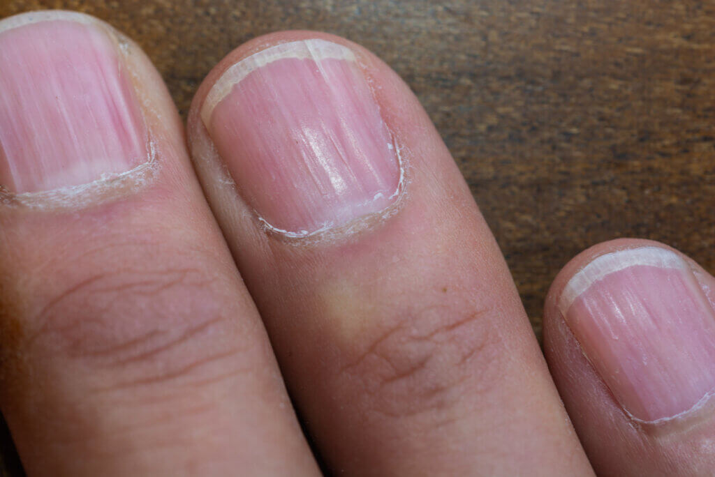 Uñas con líneas.