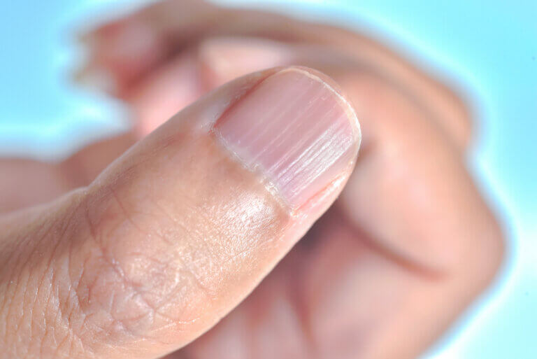 ¿Por qué aparecen líneas en las uñas y cómo eliminarlas?