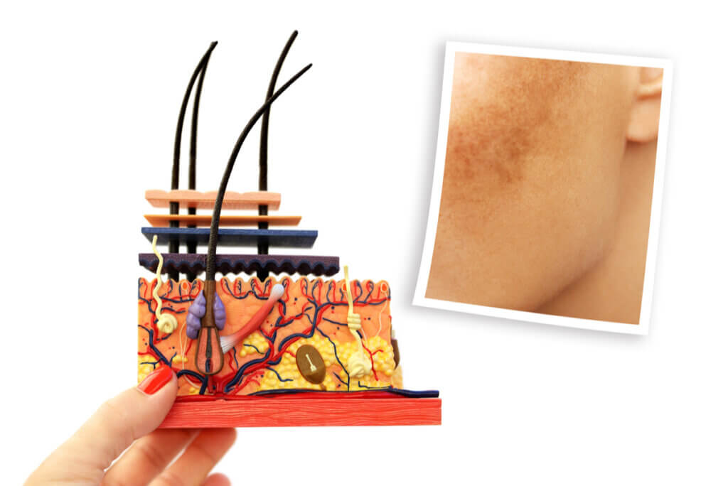 Esquema de piel con melasma.