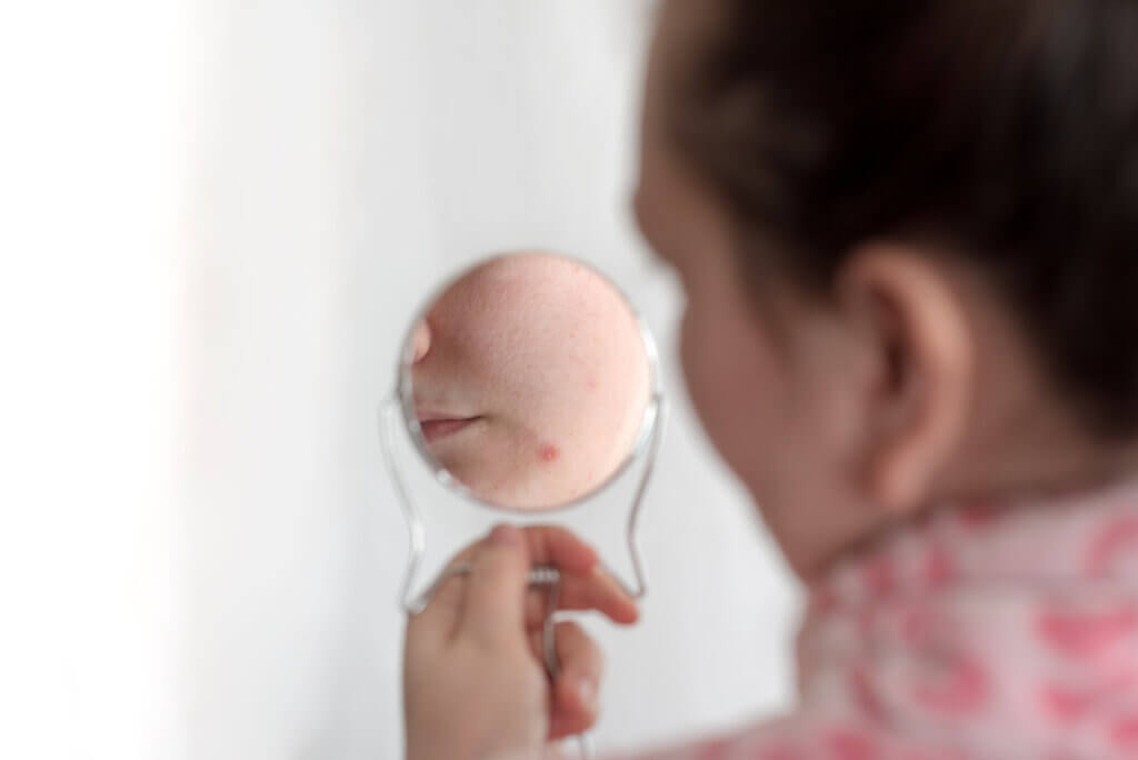 Acné pendant la grossesse due à la progestérone.
