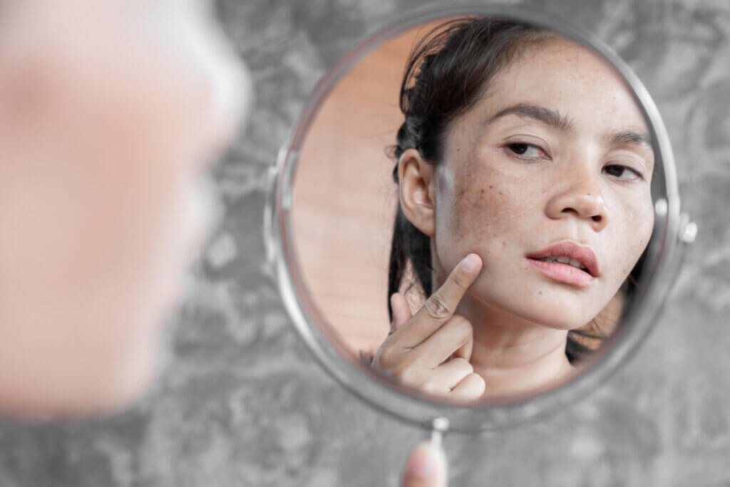 Melasma: síntomas, causas, prevención y tratamiento