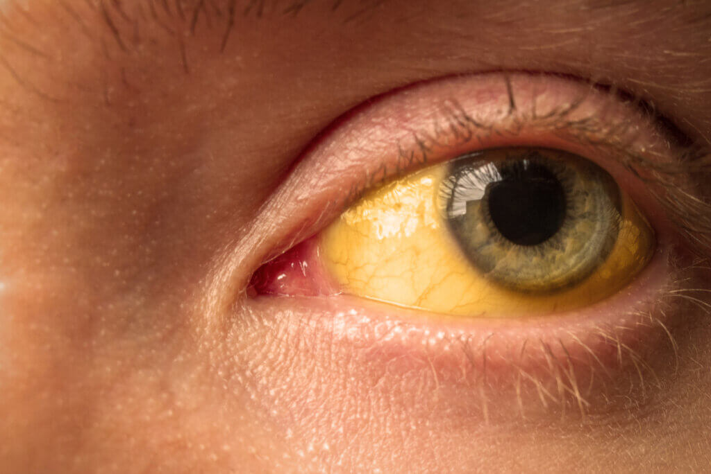 Cirrosis