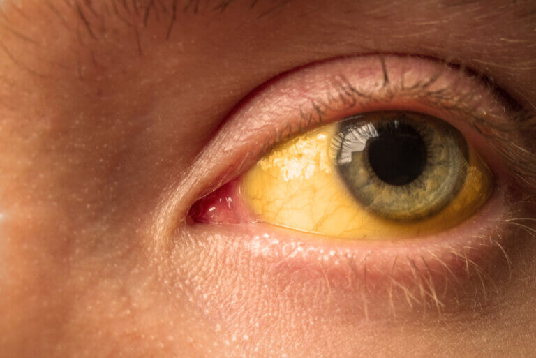 Cirrosis