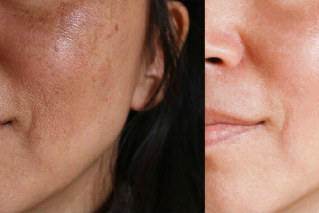 Behandeling voor melasma.