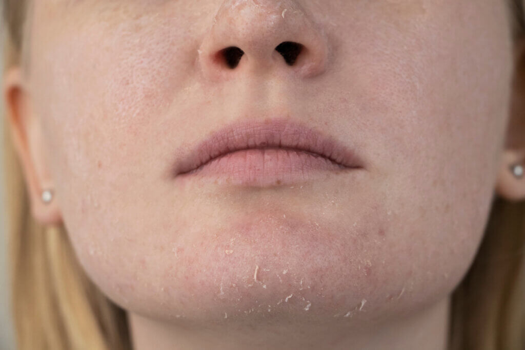 Piel seca en el rostro.