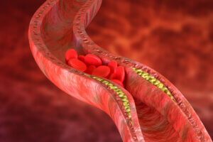 Aterosclerosis: síntomas, causas y tratamiento