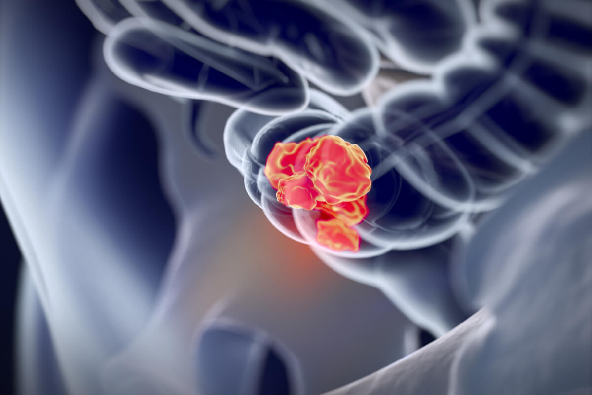 Le differenze tra la colite ulcerosa e il morbo di Crohn includono le loro complicanze