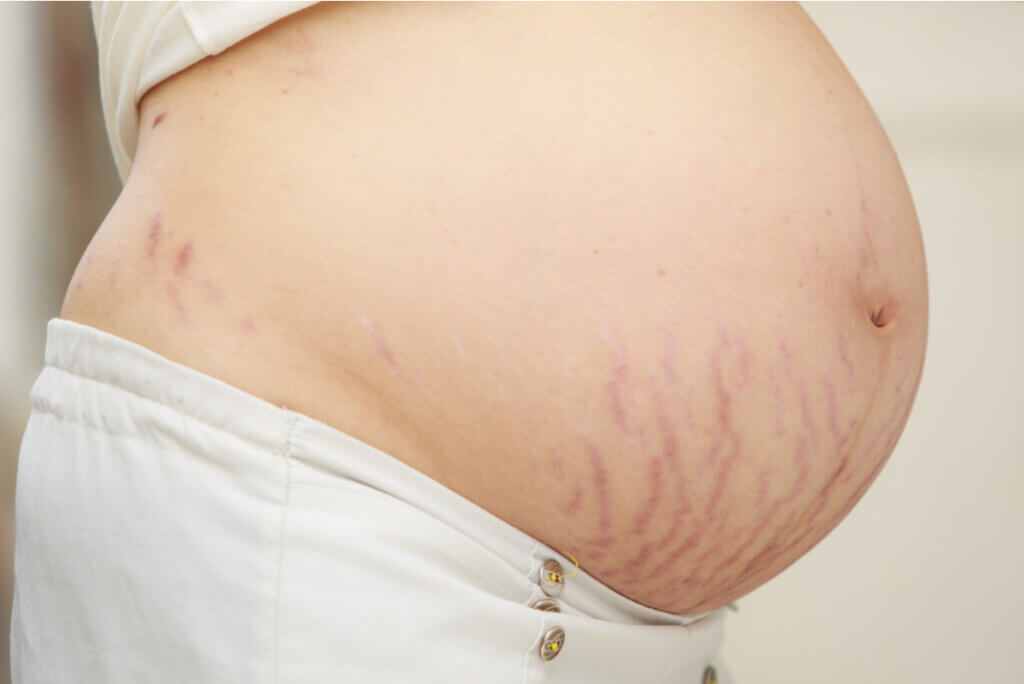 Stretch marks in pregnancy.