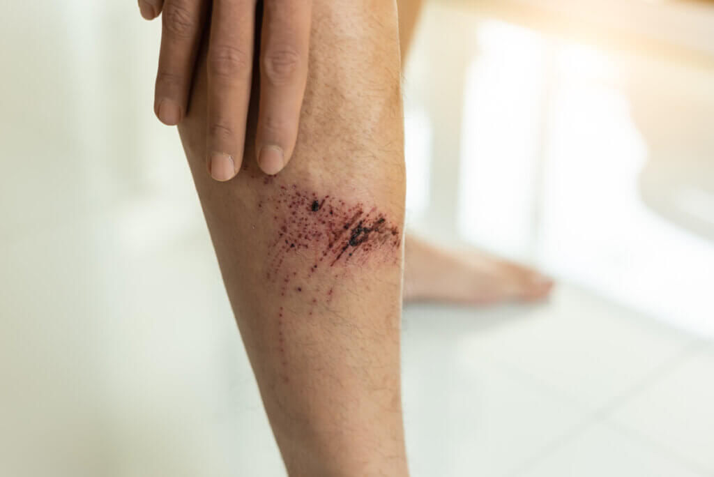 Herida superficial en pierna.