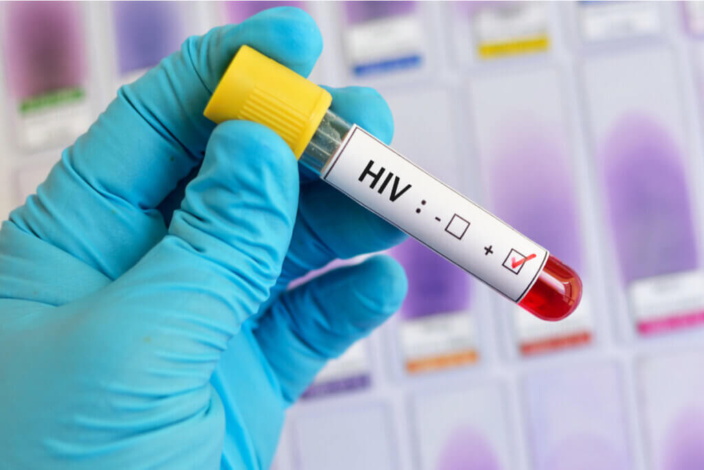 Prueba de carga viral en VIH.