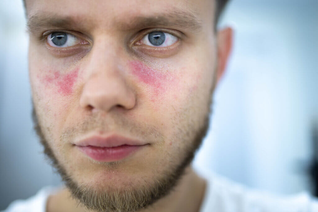 Man with lupus on his face.