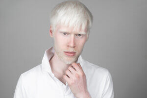 ¿Qué es el albinismo?