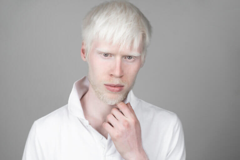 ¿Qué es el albinismo?