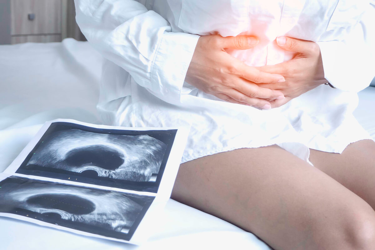 Ultrasound diagnosis of uterine fibroids