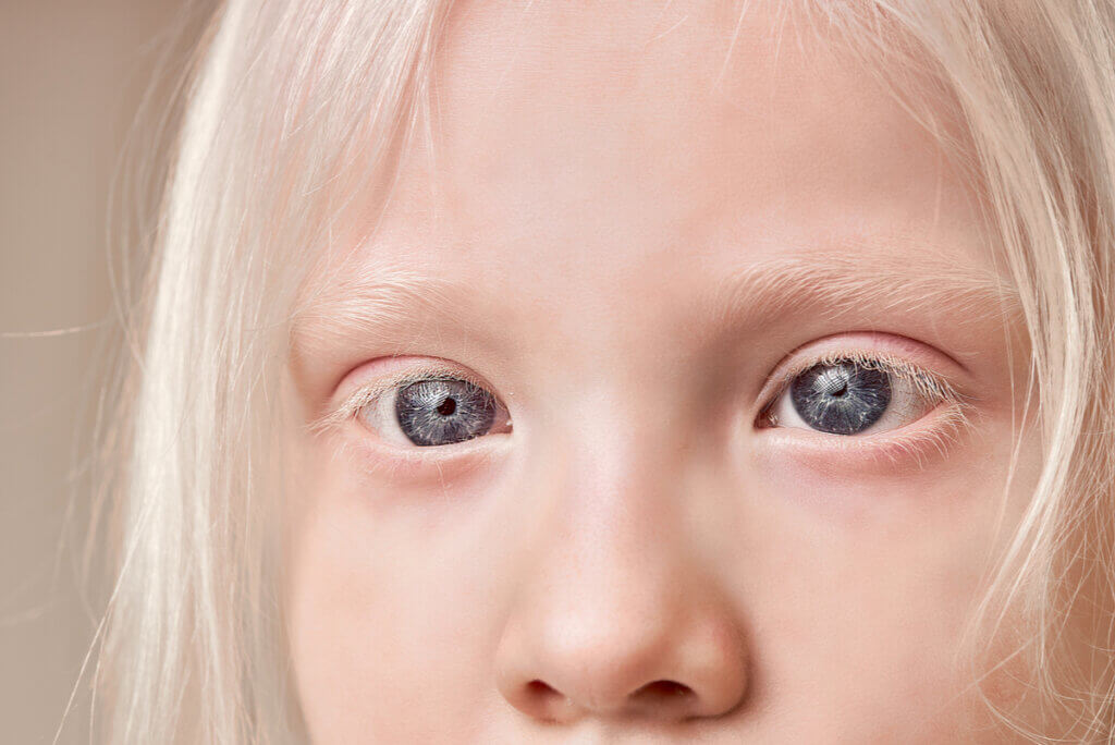 Albinismo ocular em jovem.