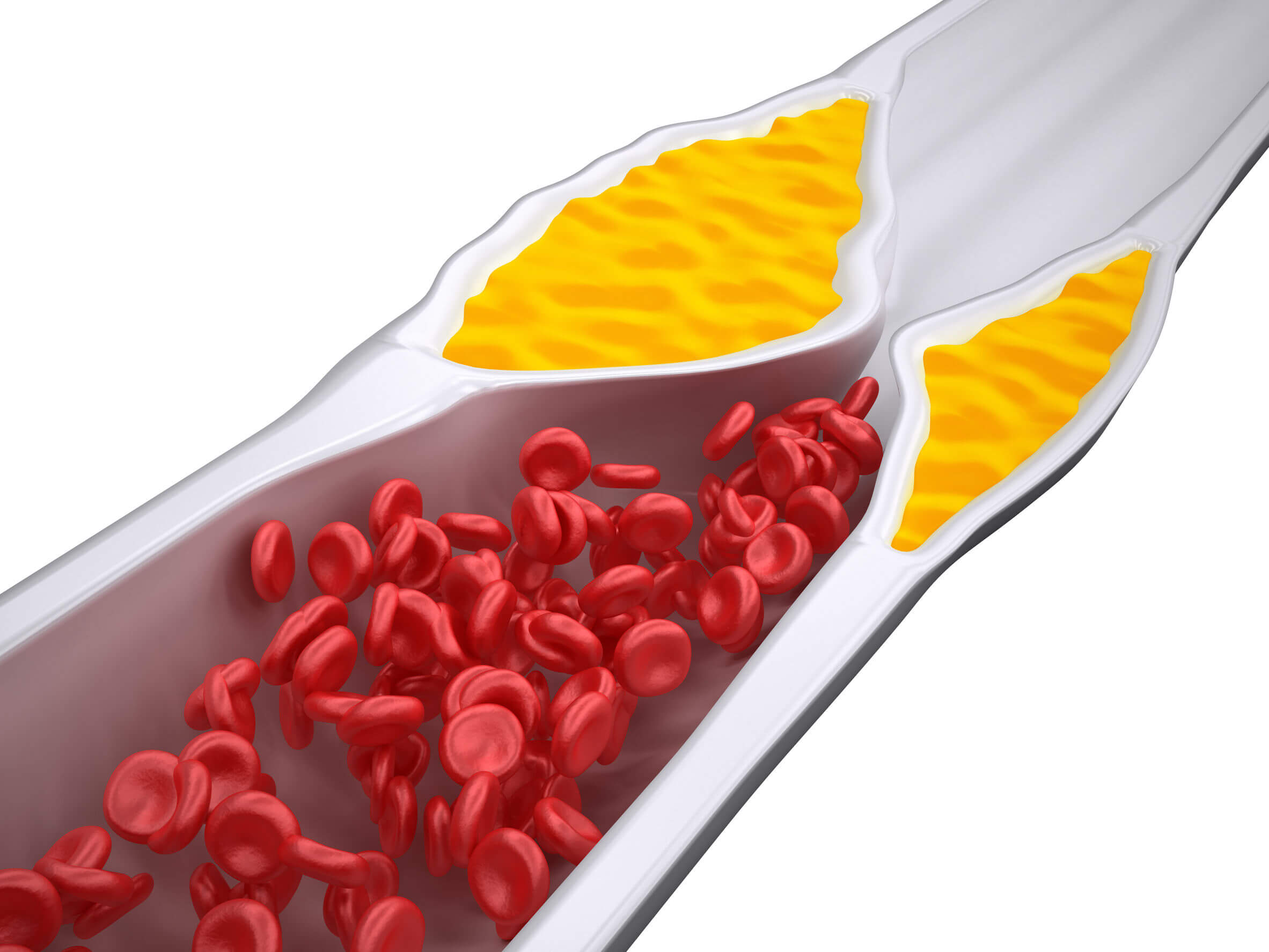 La aterosclerosis puede frenarse o prevenirse con el consumo de ácidos grasos omega 3.