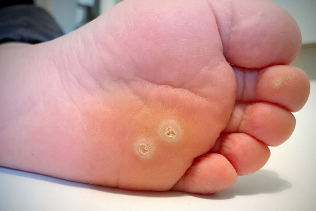 Plantar warts on the bottom of a person's foot.