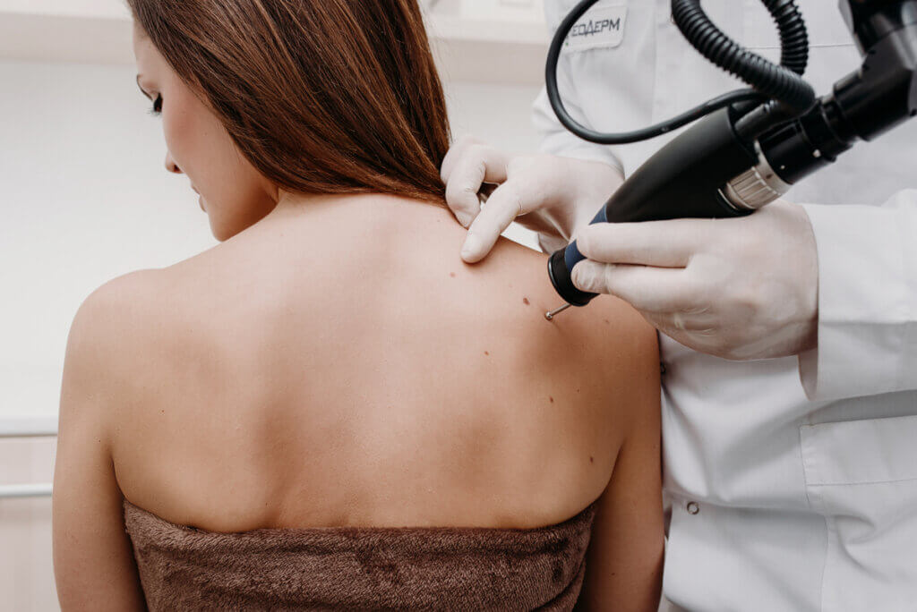 Crioterapia para verrugas.