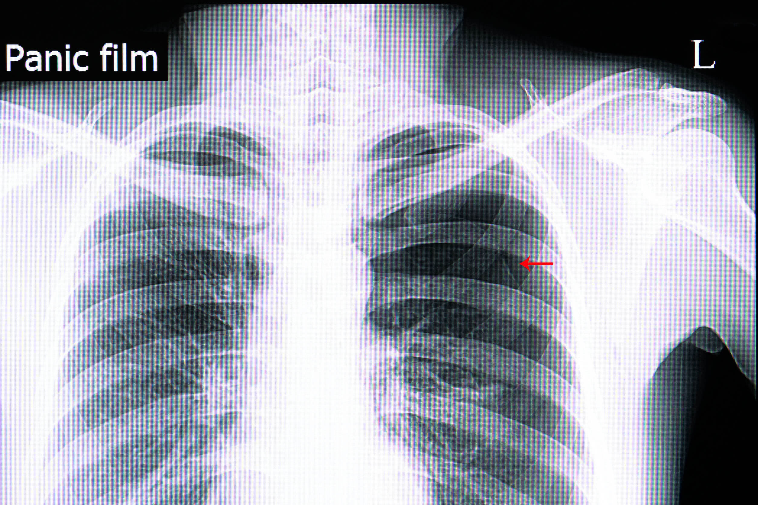 Le pneumothorax peut être diagnostiqué de plusieurs façons.