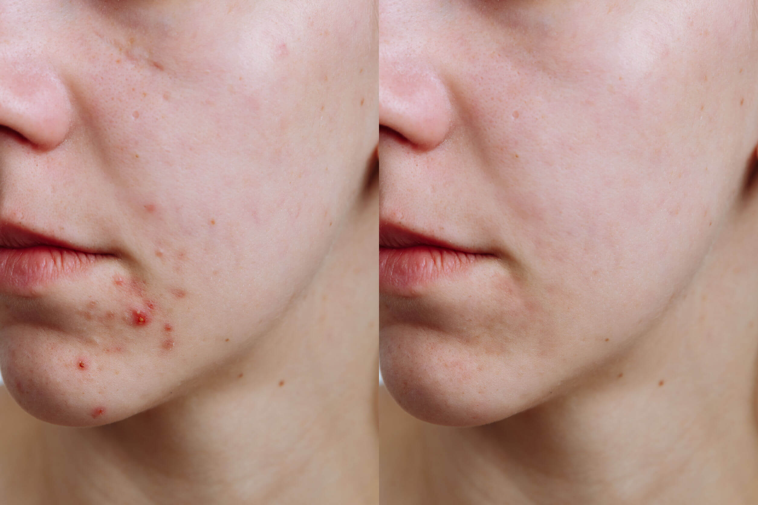 L'acne è in alcuni casi uno degli effetti del clima sulla pelle 