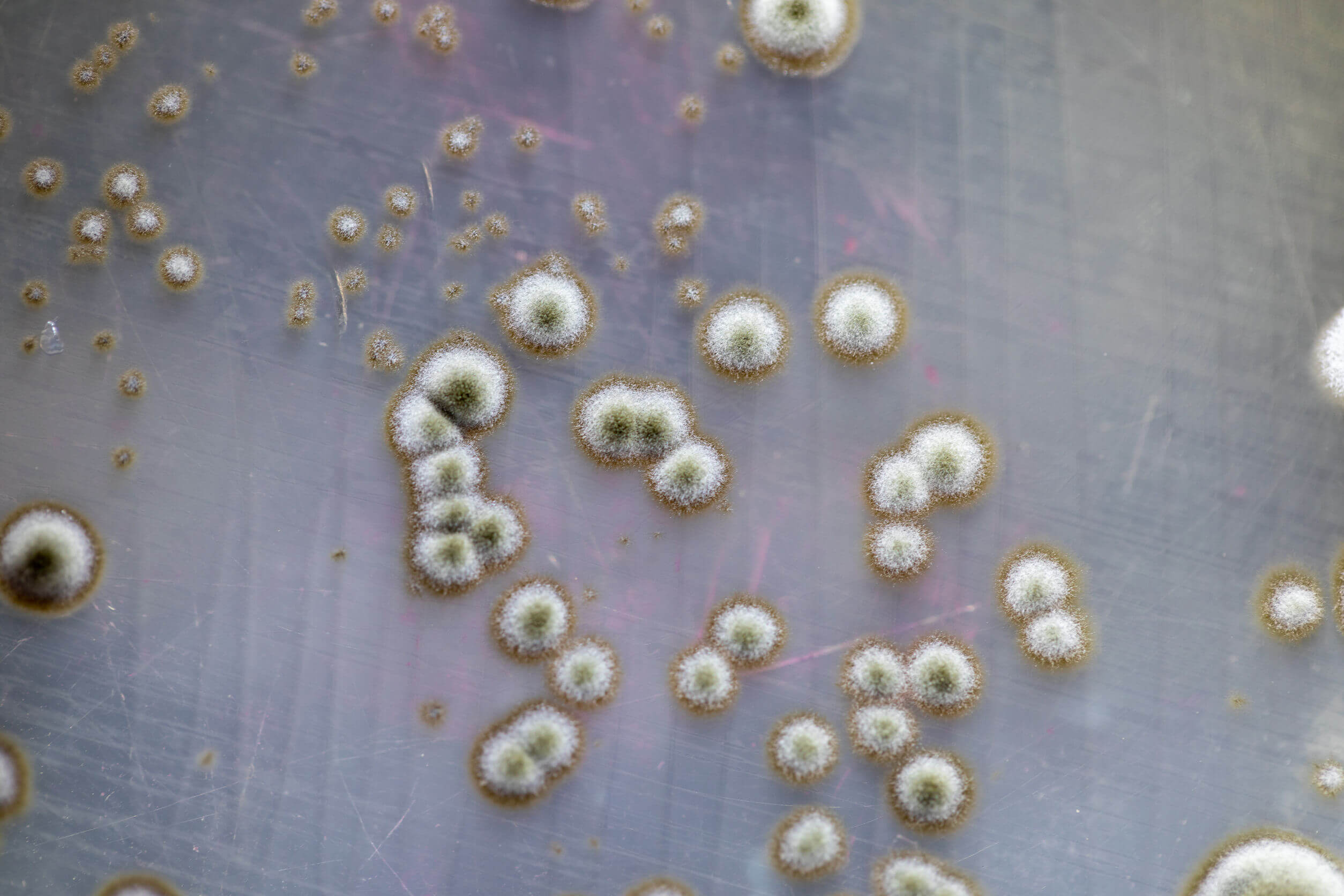 La infección por hongos puede generar caspa.