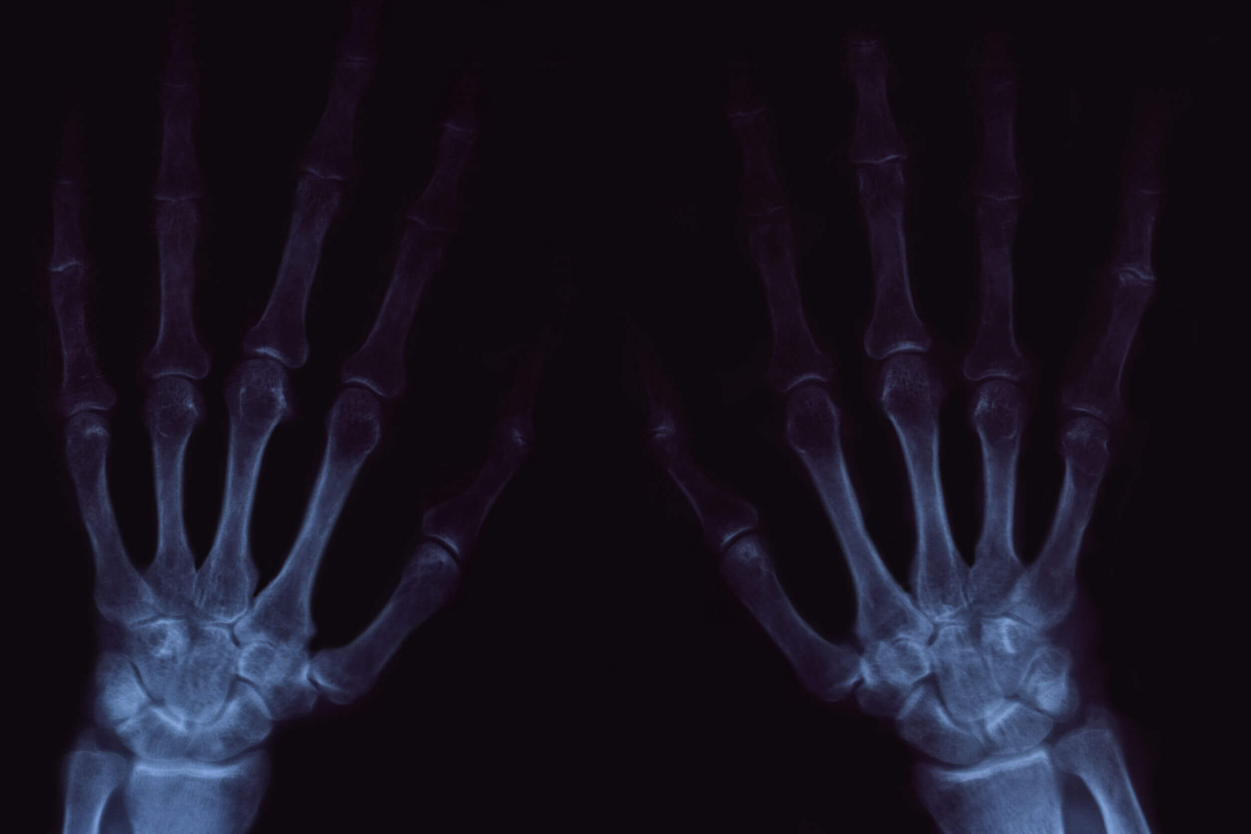 The cracking of the joints can be painful in cases of osteoarthritis.