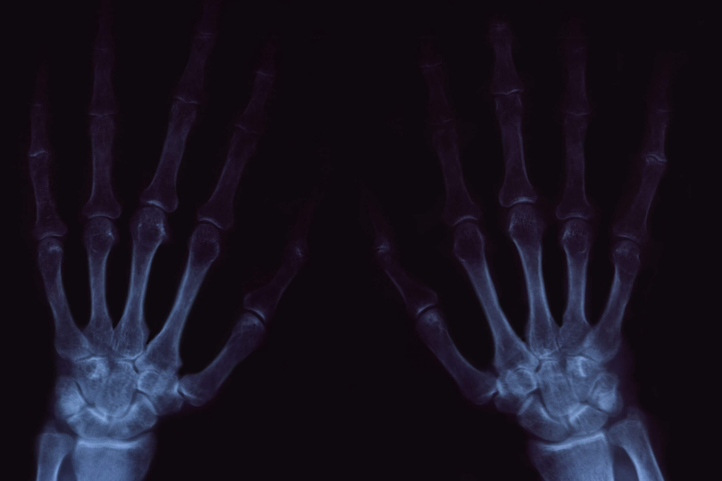 El crujido de las articulaciones puede ser doloroso en los casos de artrosis.