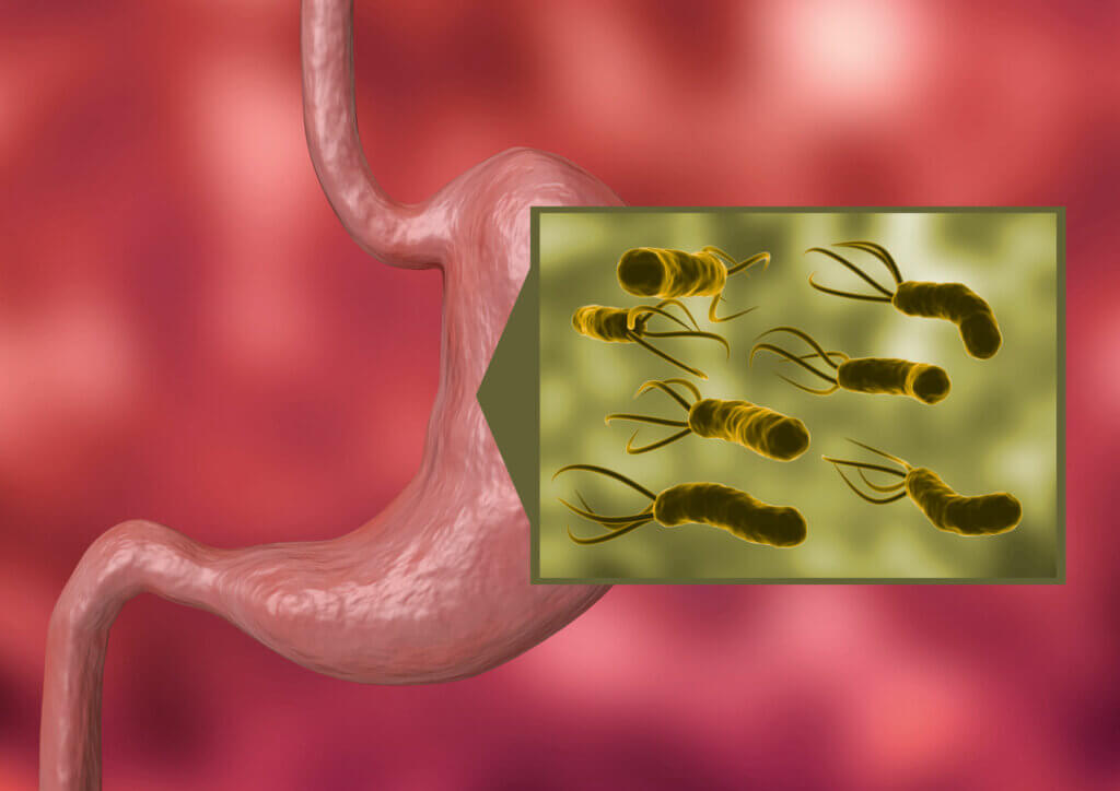 Entre los tipos de gastritis están aquellos producidos por bacterias